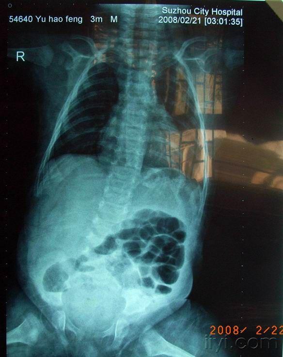 肠套叠x线典型征象图片