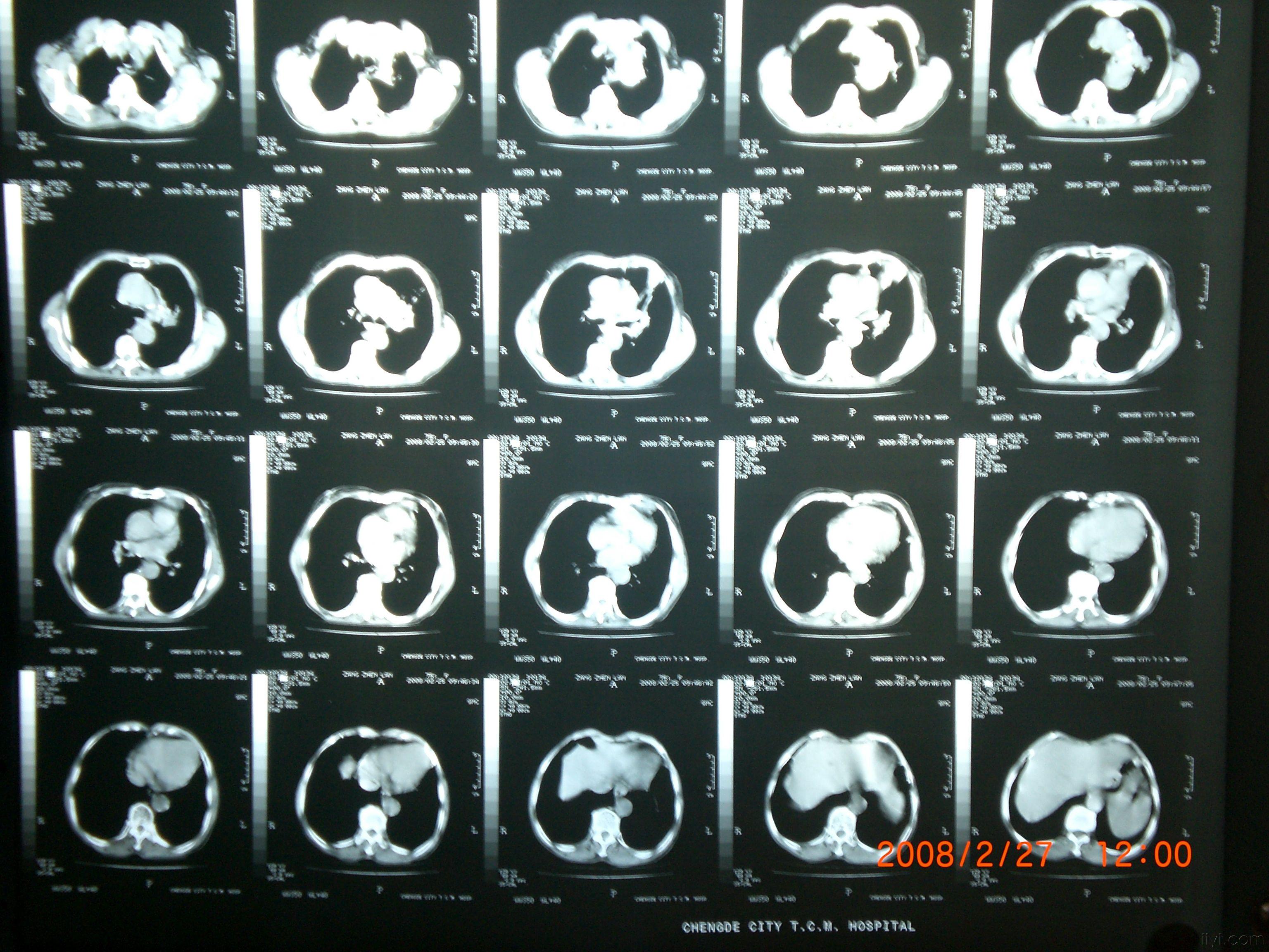 请大家看一下这张胸片该如何诊断结果公布