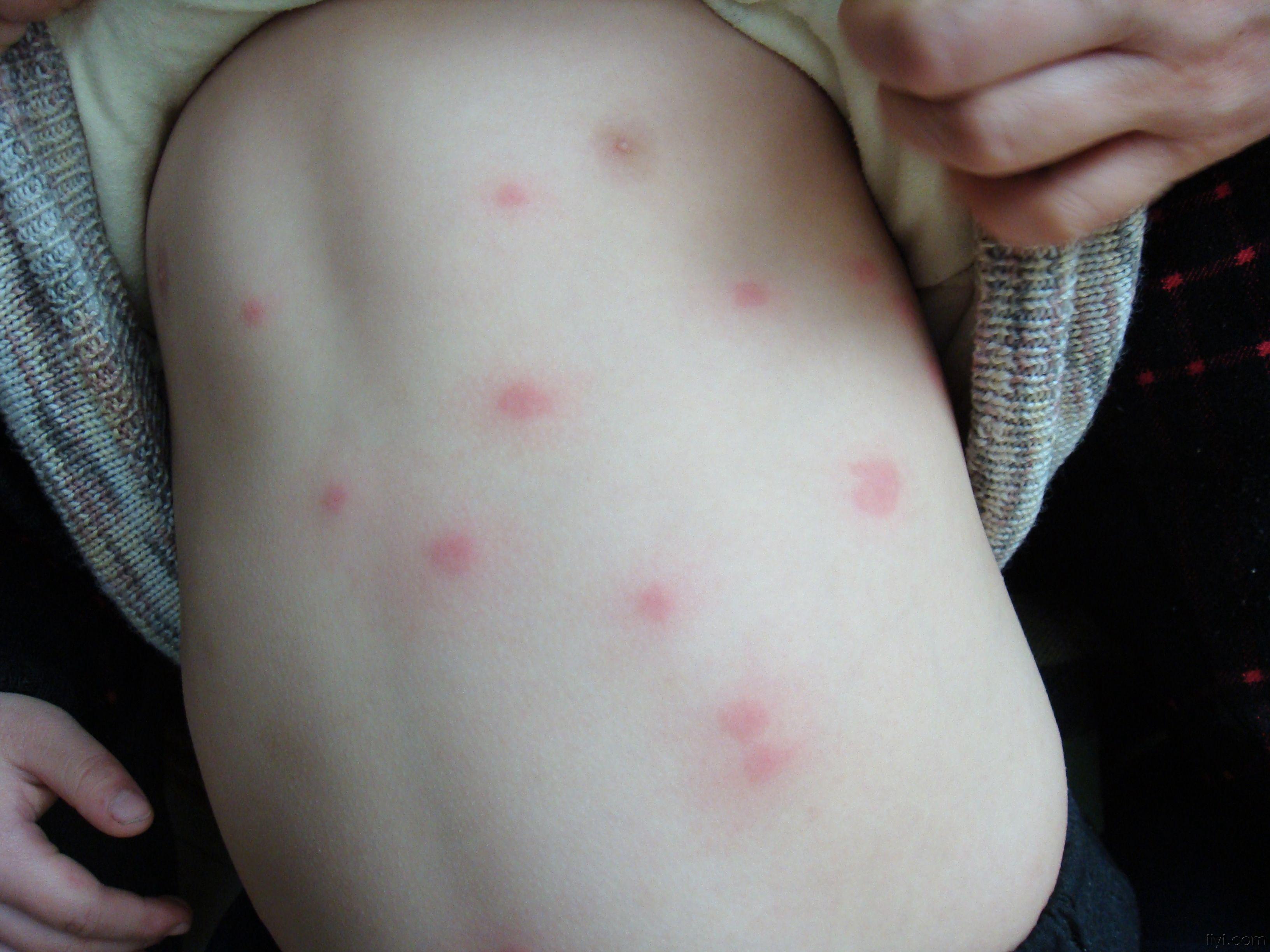 丘疹性荨麻疹辨别图片图片