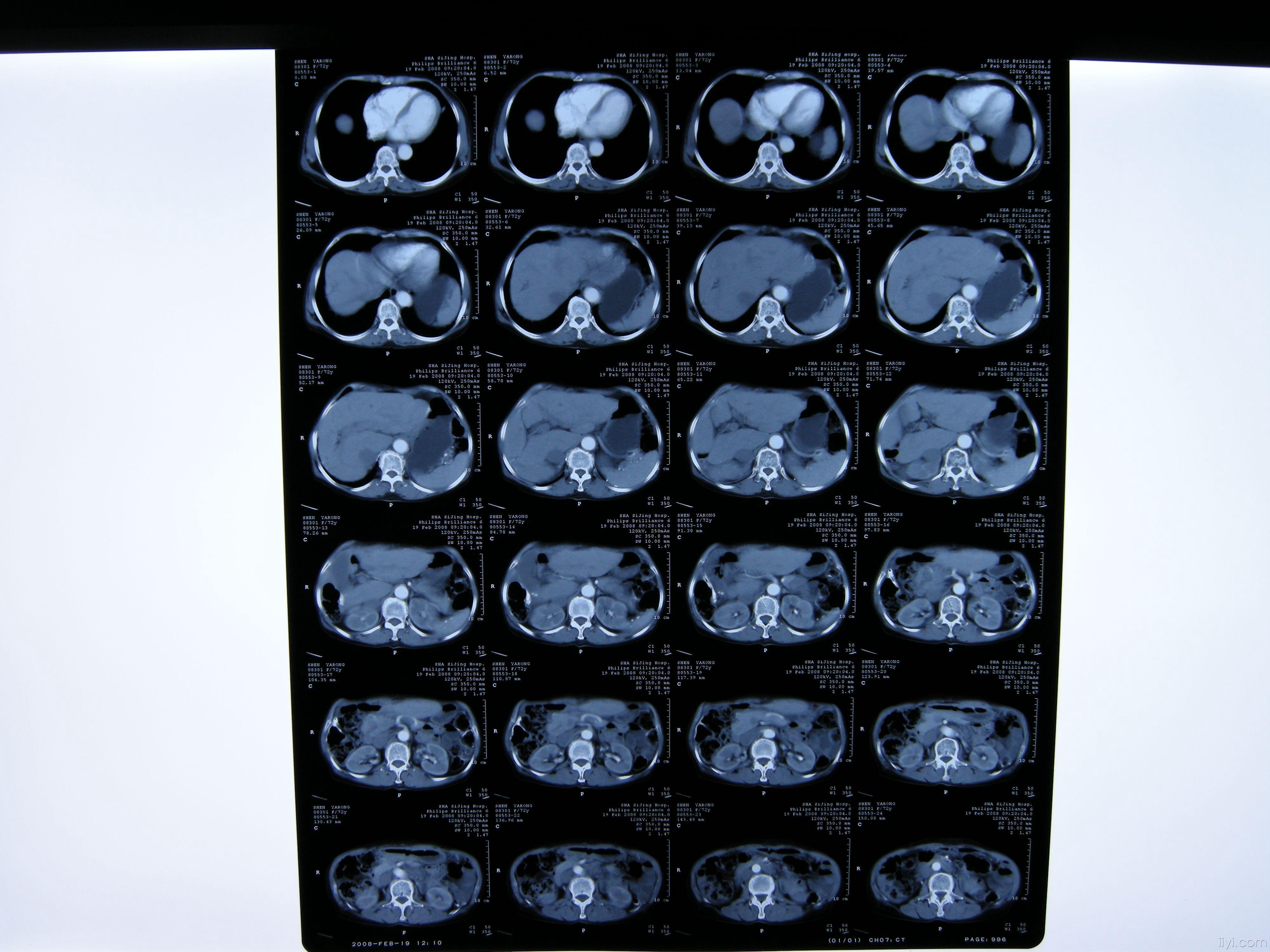 腹部肿块病例讨论一例