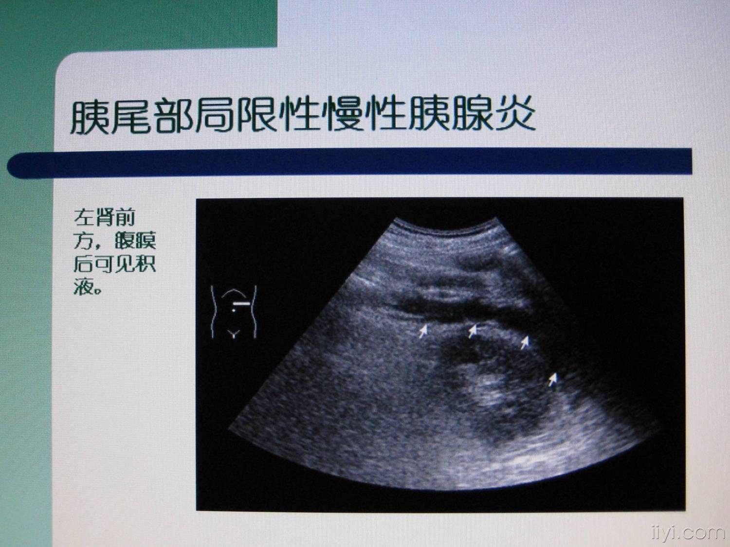 环状胰腺超声图像图片