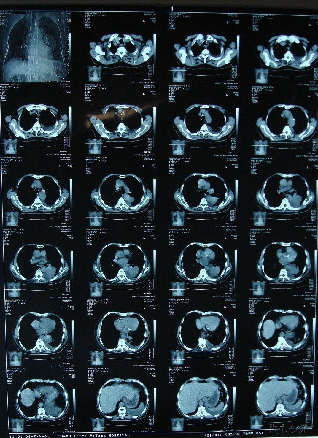 胸椎核磁图片图片