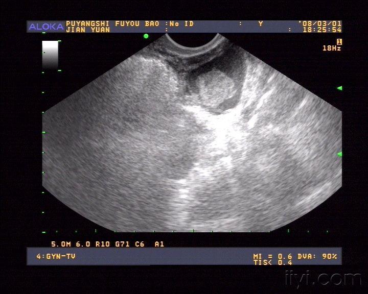 快看看这典型的黄体血肿啊