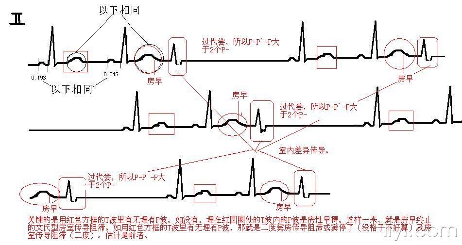 房性心律心电图口诀图片