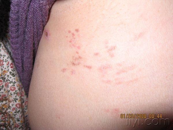 看图猜病:6张病例图片 - 皮肤及性传播疾病讨论版 - 爱爱医医学论坛