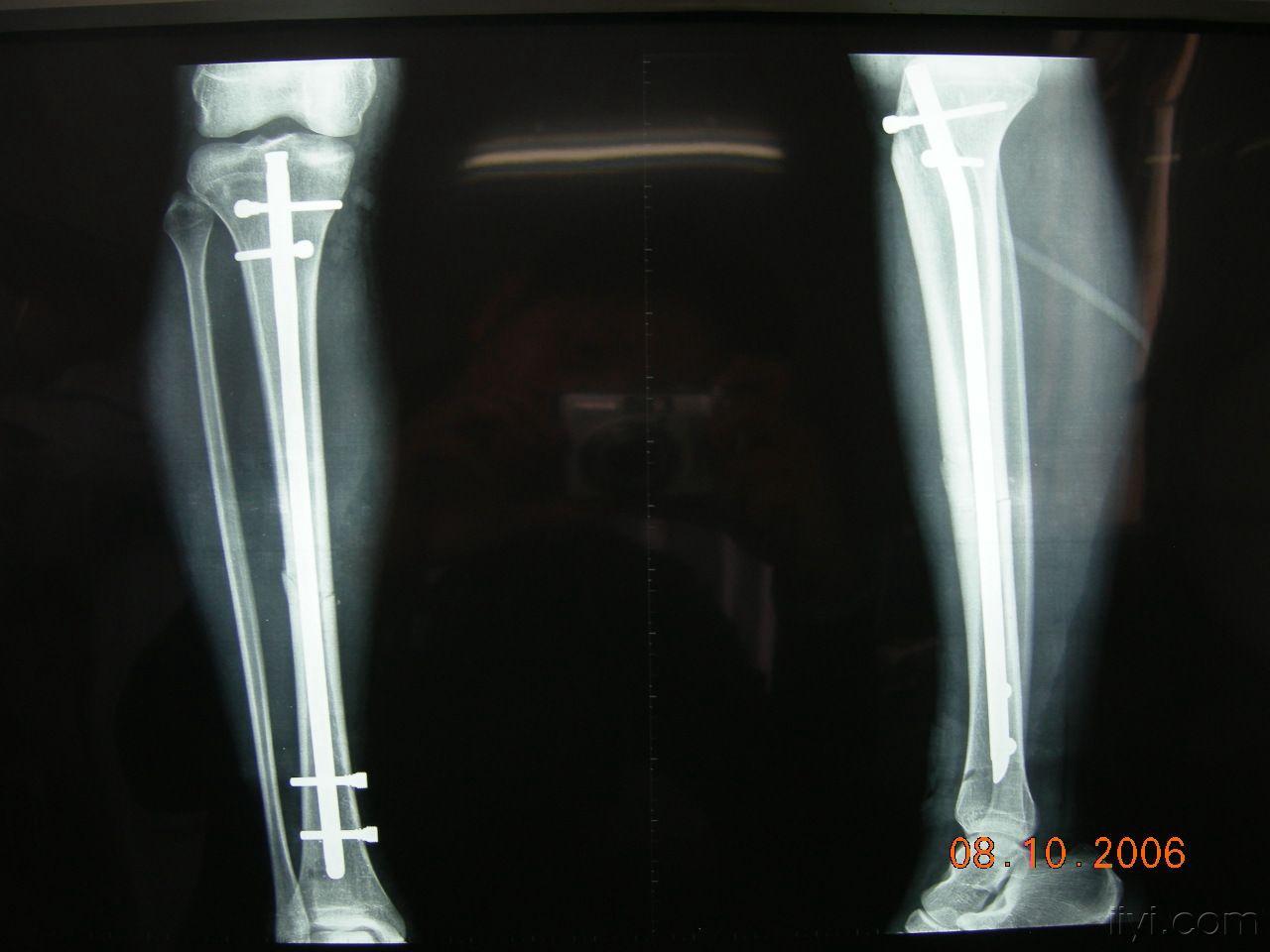 右手第五掌骨骨折，术后3周，说下现在恢复情况 - 知乎