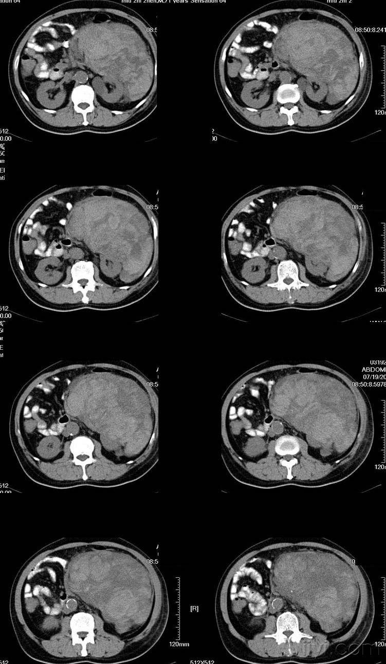转贴左上腹肿块