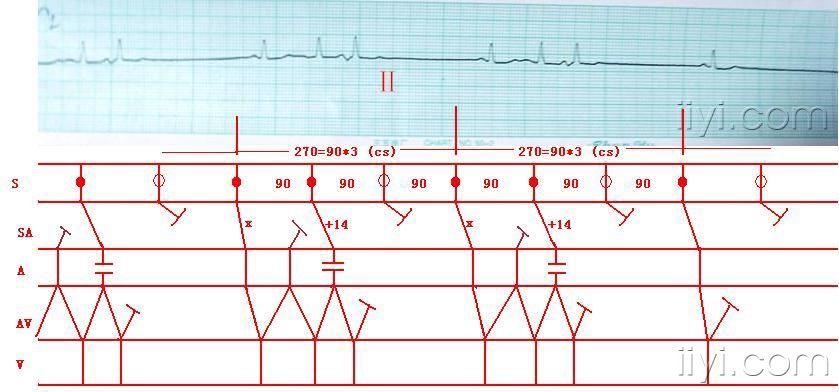 心电图学习20080318