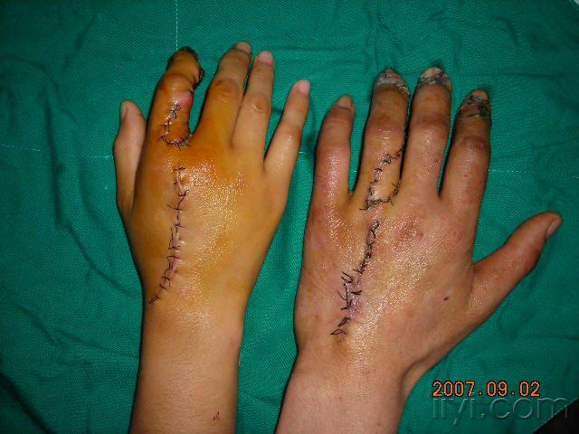 掌背皮神经营养皮瓣修复供皮瓣区创面