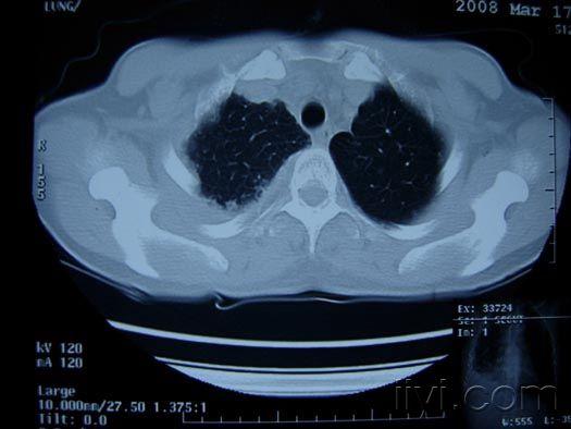 胸膜增厚影像图图片