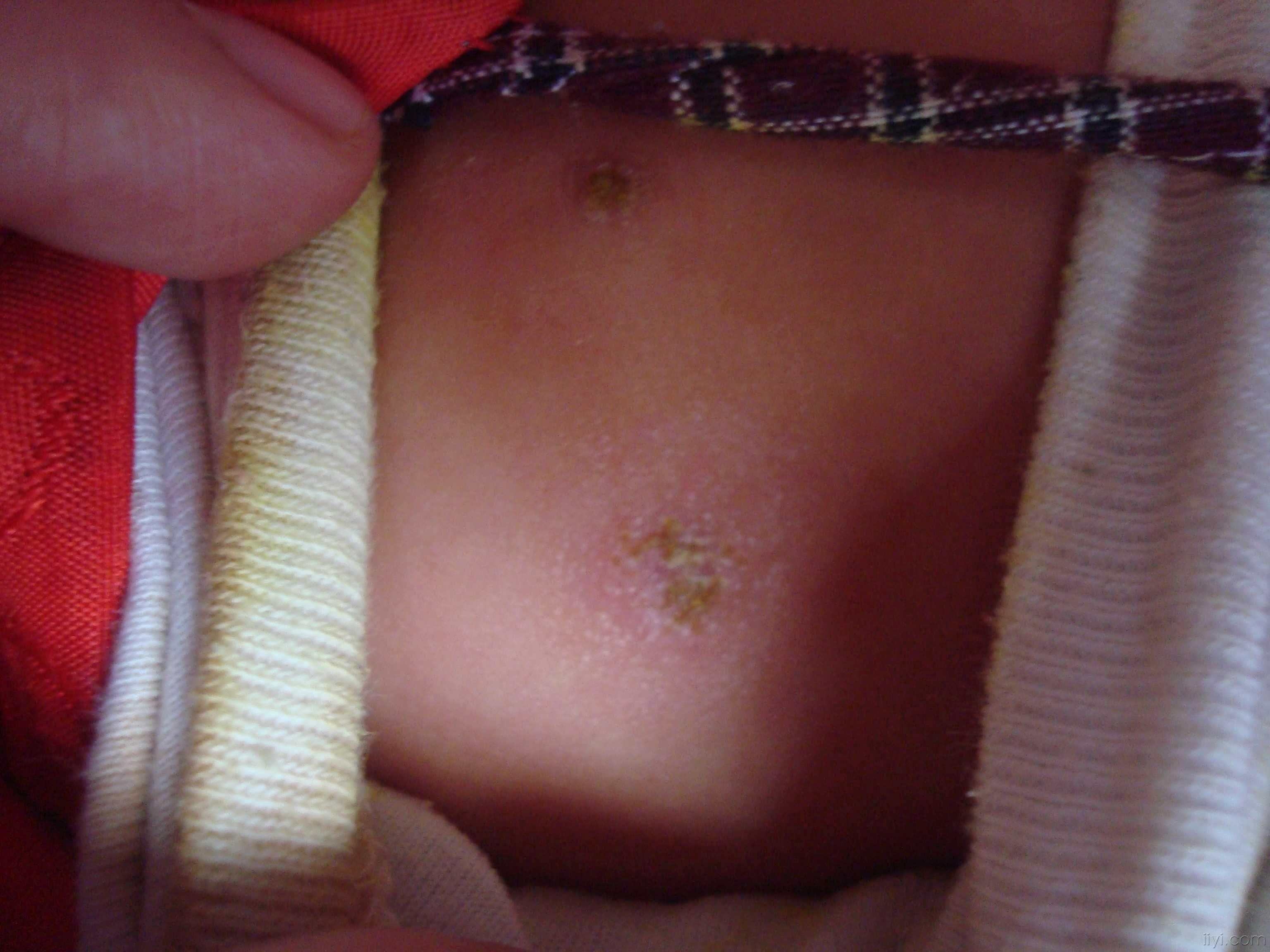 宝宝感染梅毒皮肤照片图片