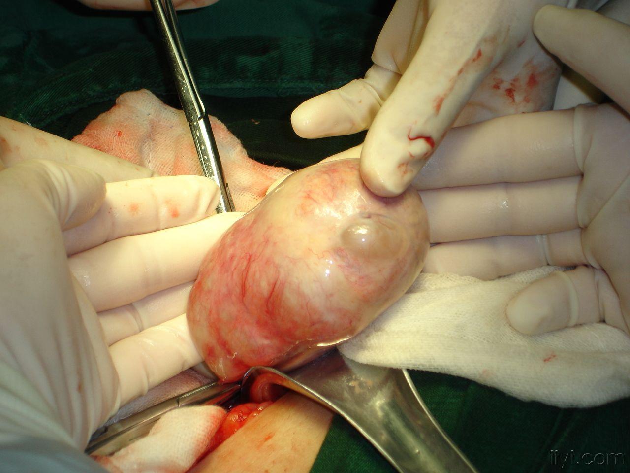 一例典型畸胎瘤声像图