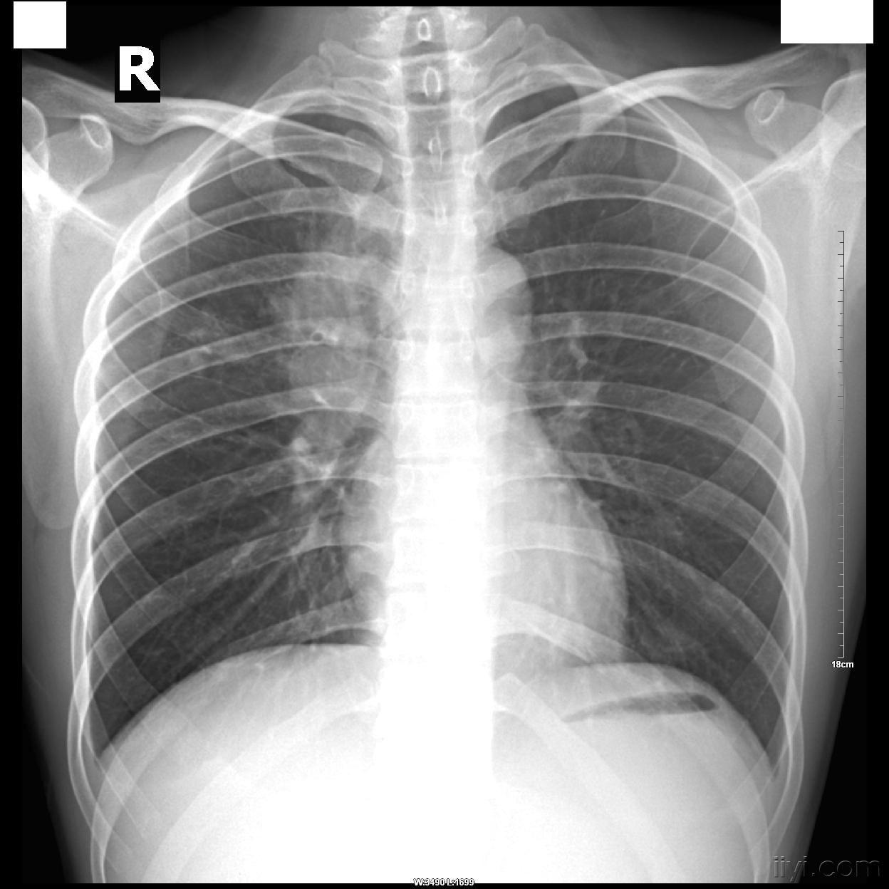 肺门淋巴结CT图片