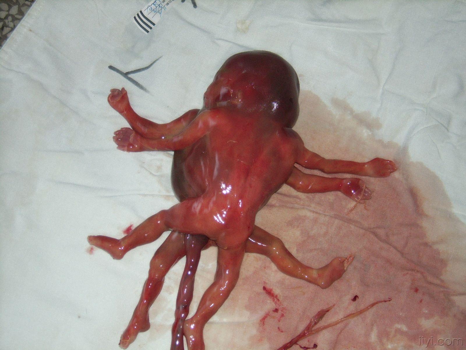 六个月引产胎儿图图片