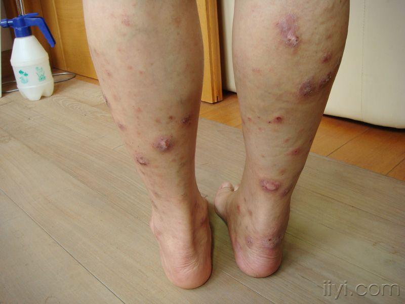 二足底及二小腿皮肤瘙痒难忍十年 - 皮肤及性传播疾病讨论版 - 爱爱医