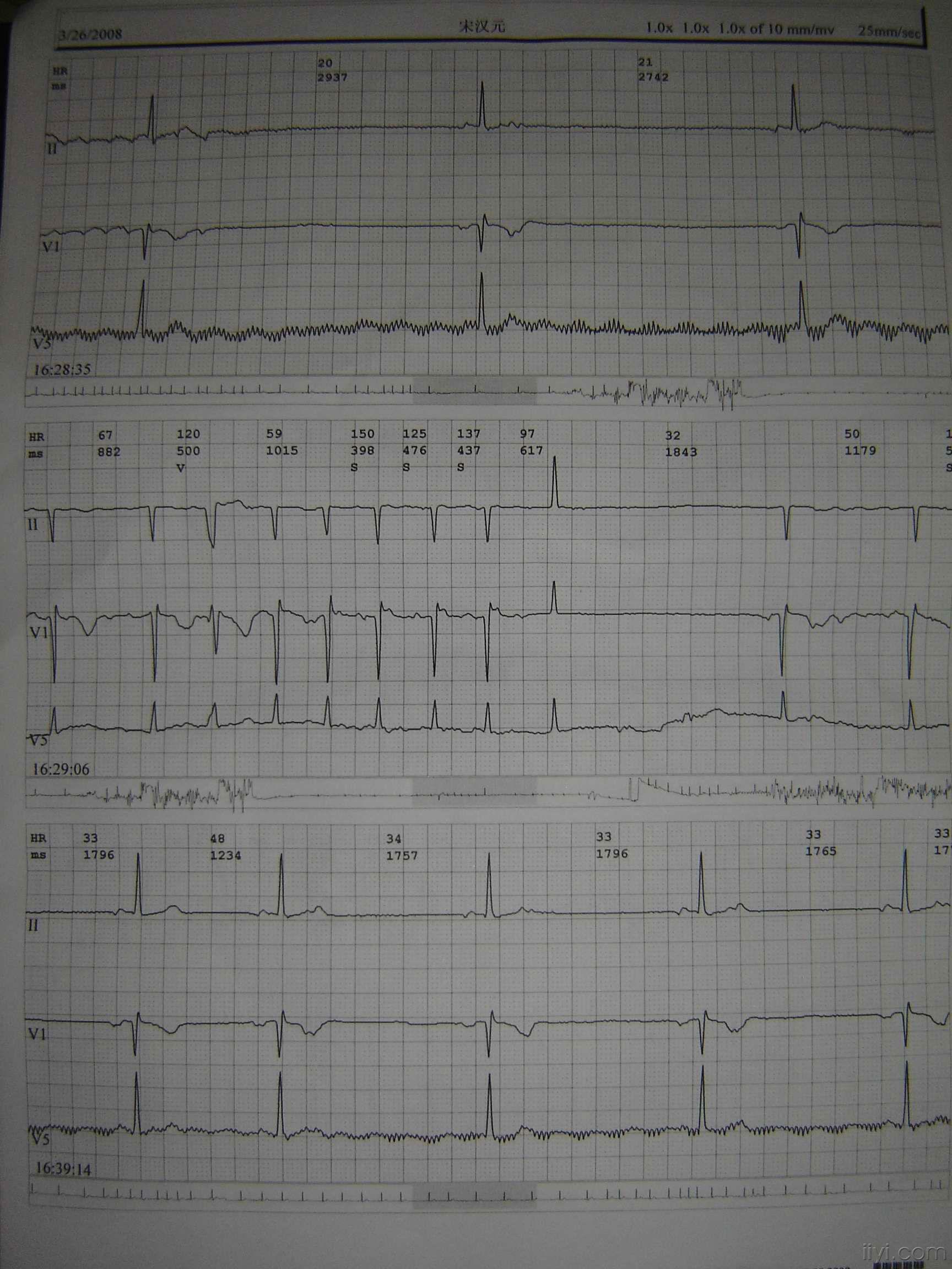 窦房结心电图特征图片