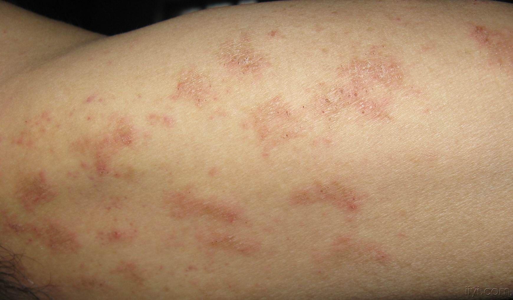 病毒皮肤感染症状图片图片