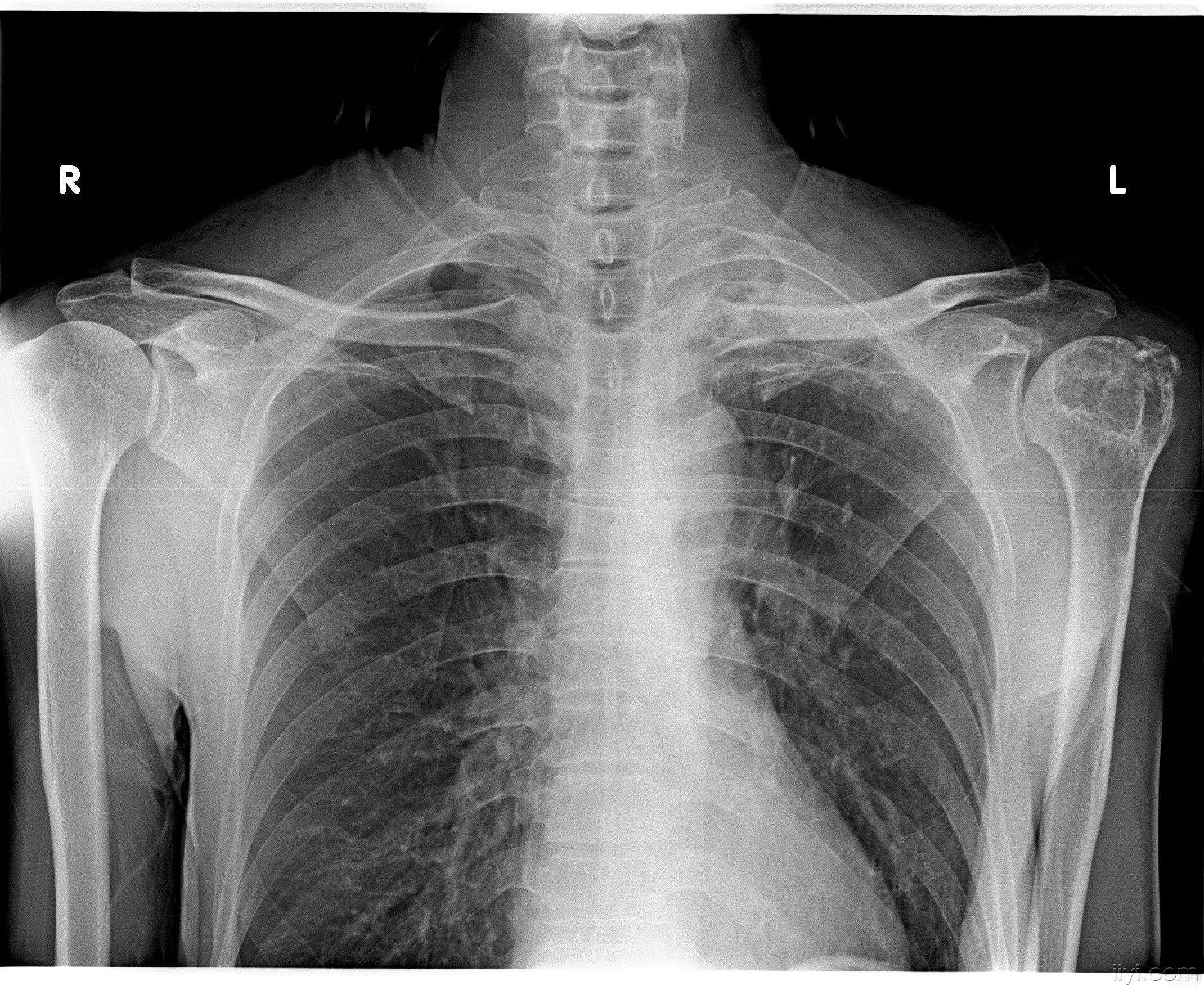 人体肩膀骨骼x光片图片