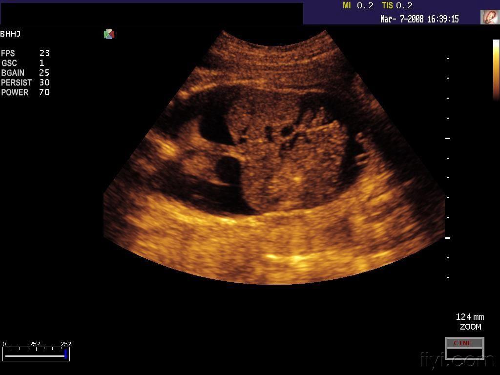 胎儿水肿及胸腹腔积液