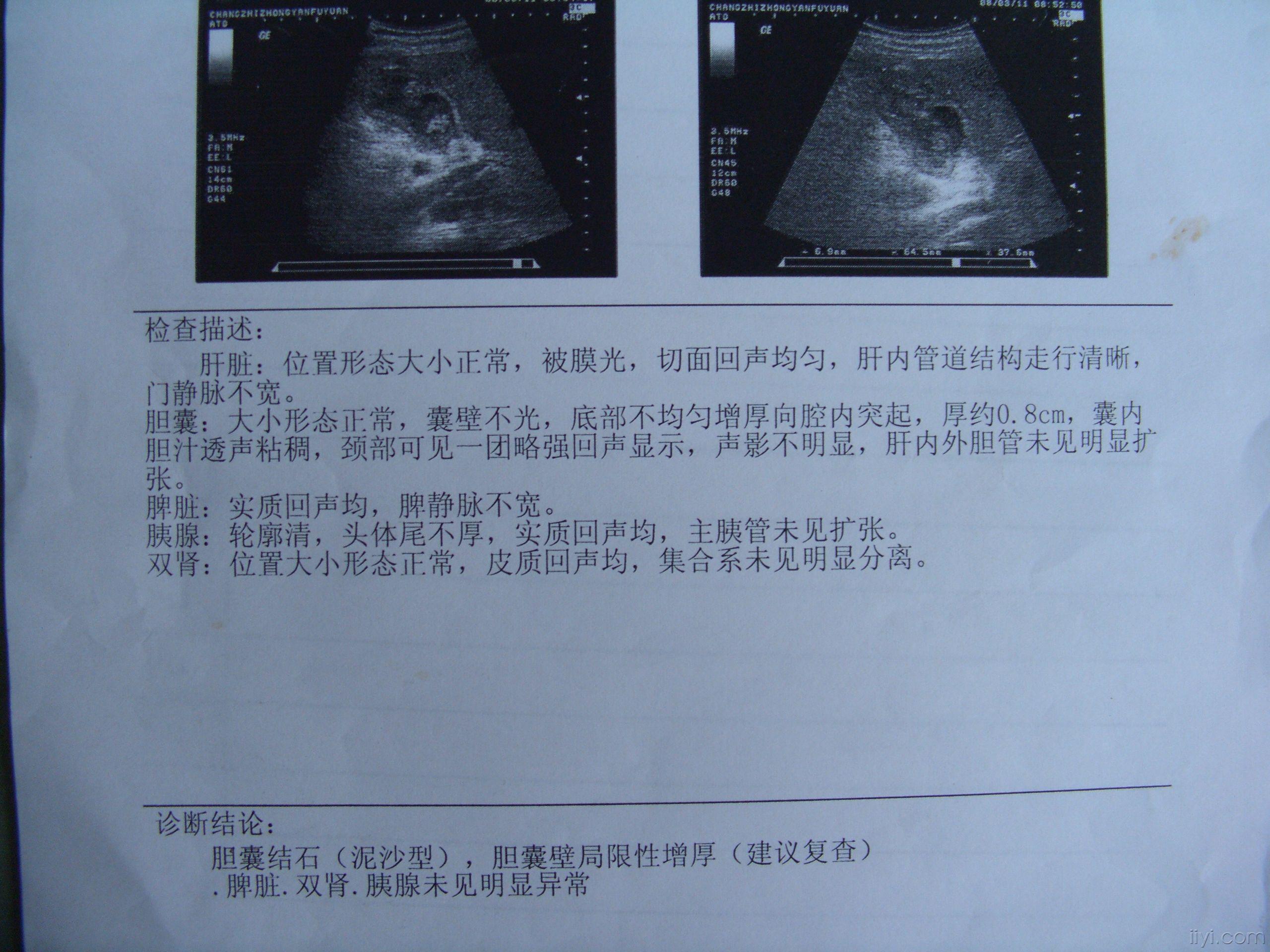 獭尾肝超声图片