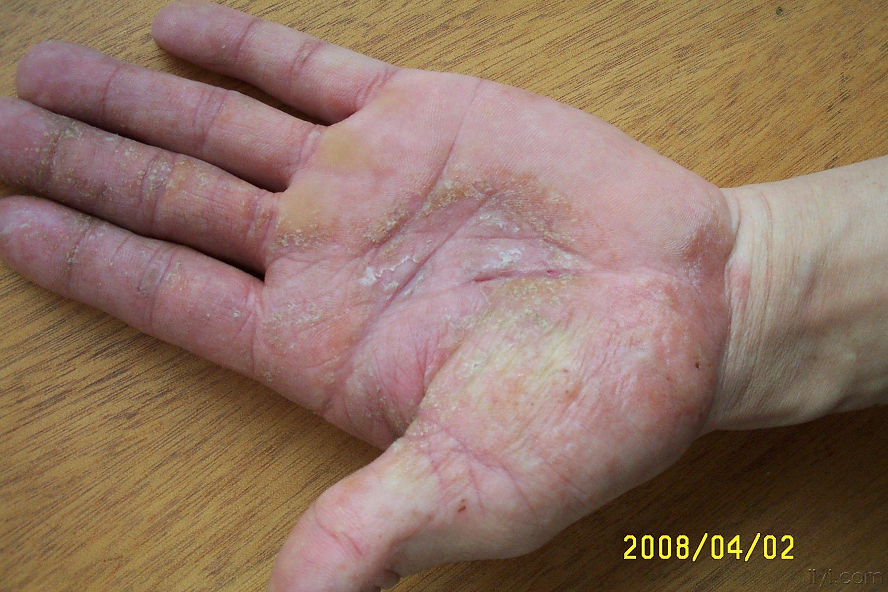 第一例:湿疹?手癣?