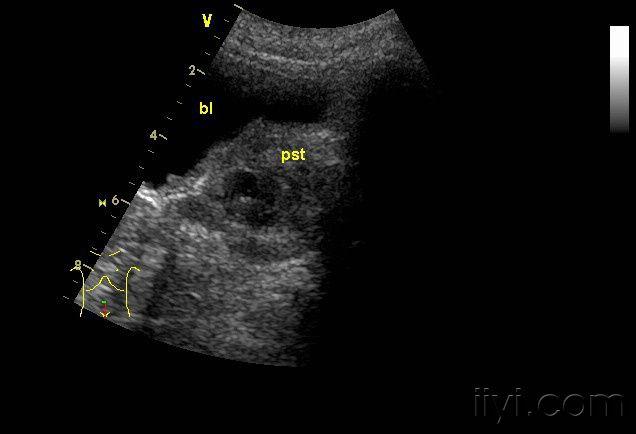 膀胱癌超声图片