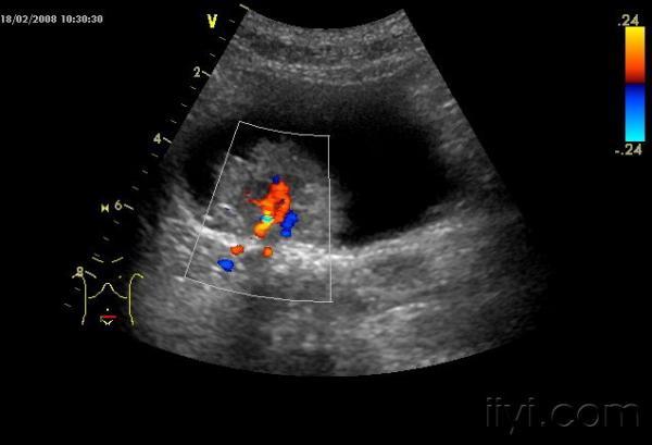 肿瘤内丰富血流