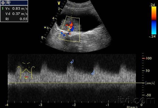频谱呈高速血流