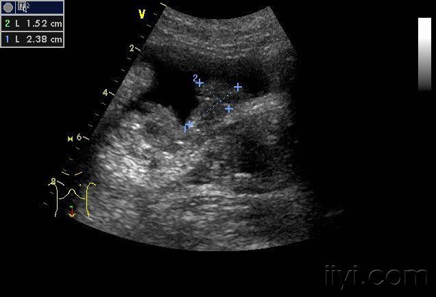 膀胱癌超声图片