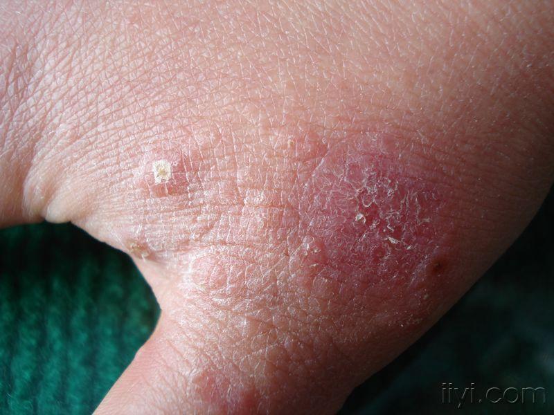 是疥疮吗 - 皮肤及性传播疾病讨论版 - 爱爱医医学论坛