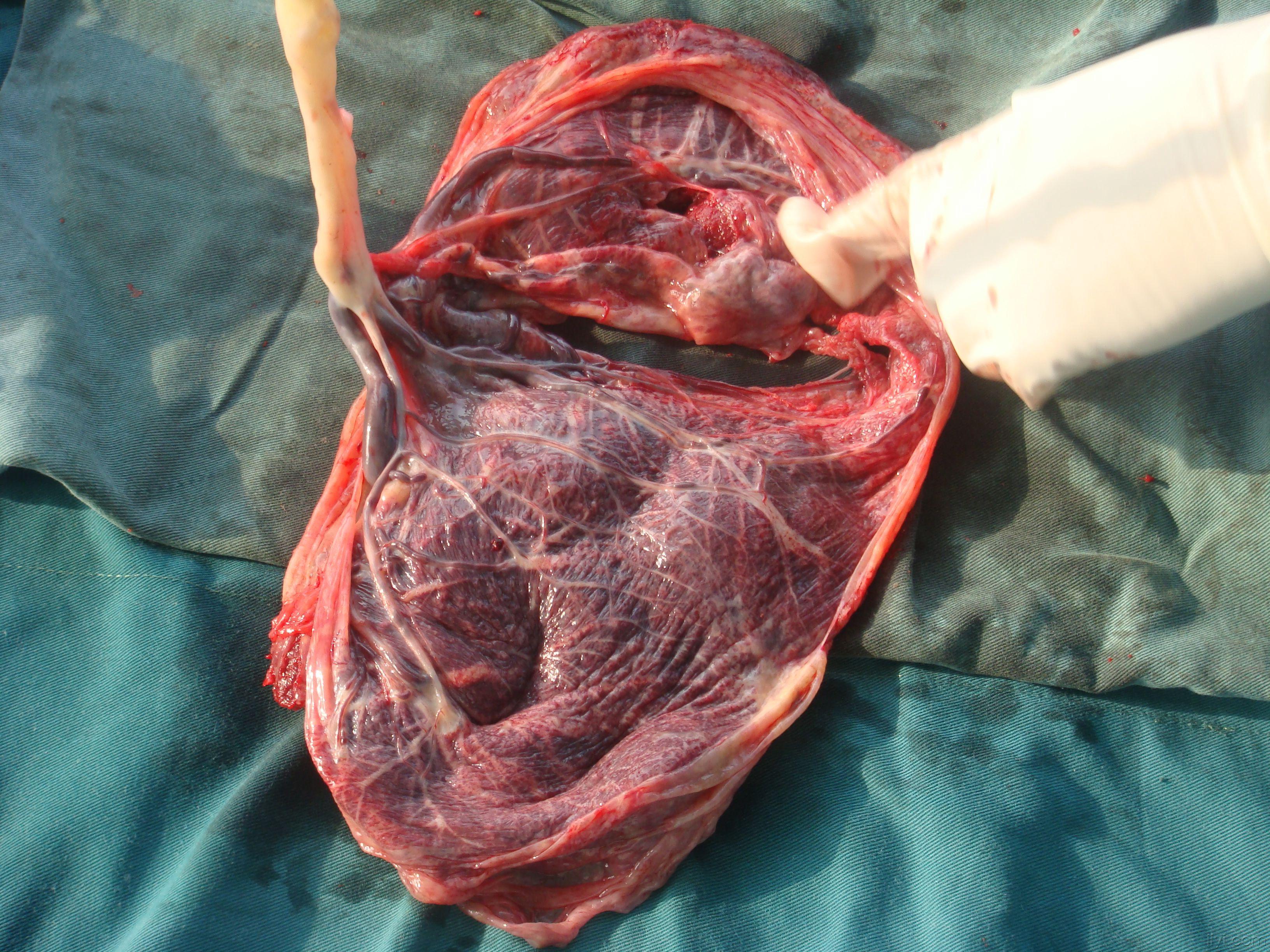 脐带血管在胎膜处分成两支,直接供应两胎盘,不同于一般的副胎盘