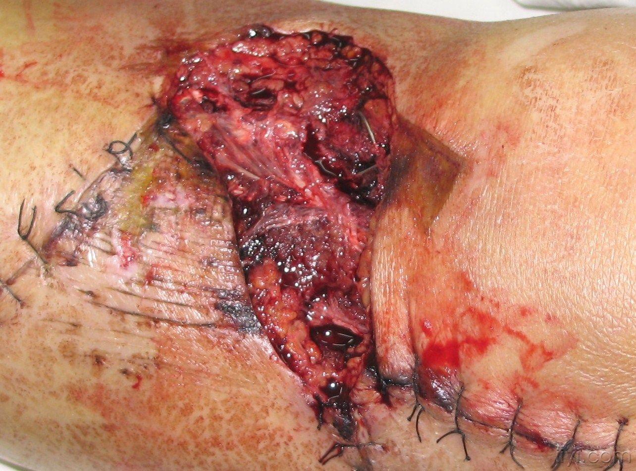 三例腓肠神经筋膜蒂皮瓣修复下肢软组织缺损