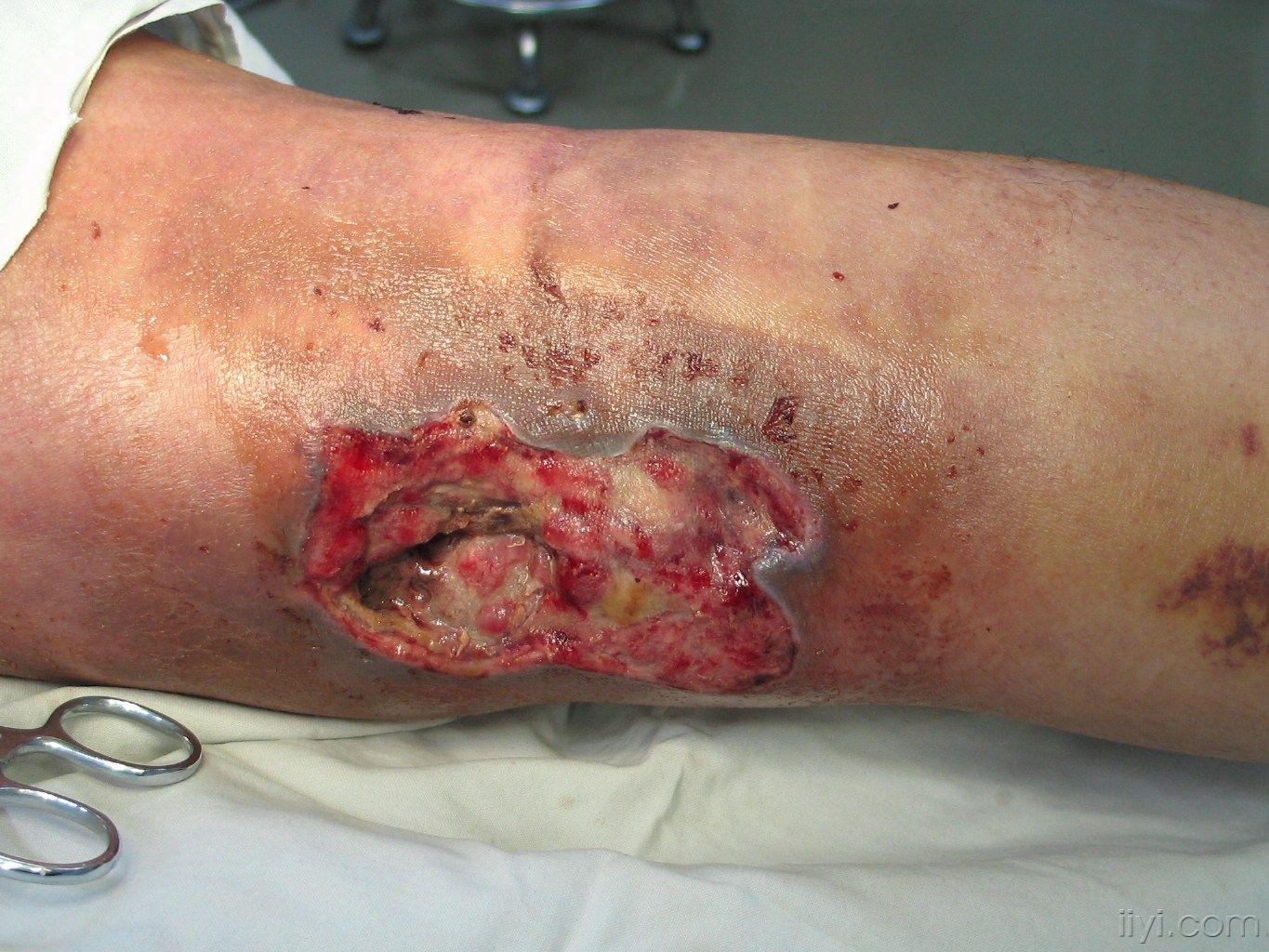 三例腓肠神经筋膜蒂皮瓣修复下肢软组织缺损