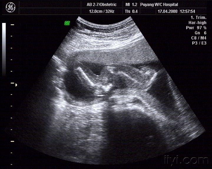 胎儿双叶征超声图片图片