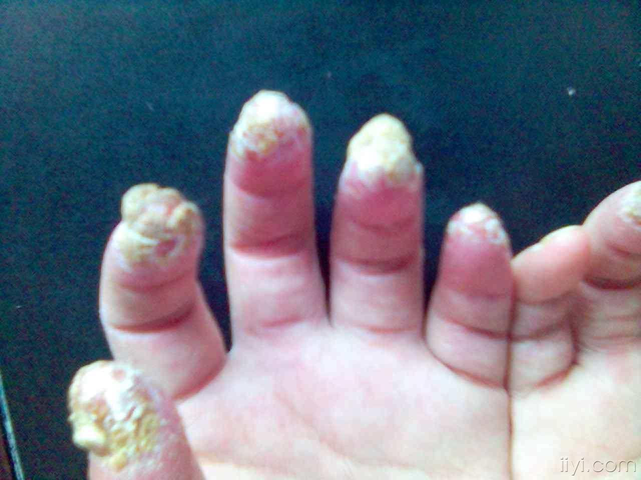 请大家看看比较严重的指甲毛病