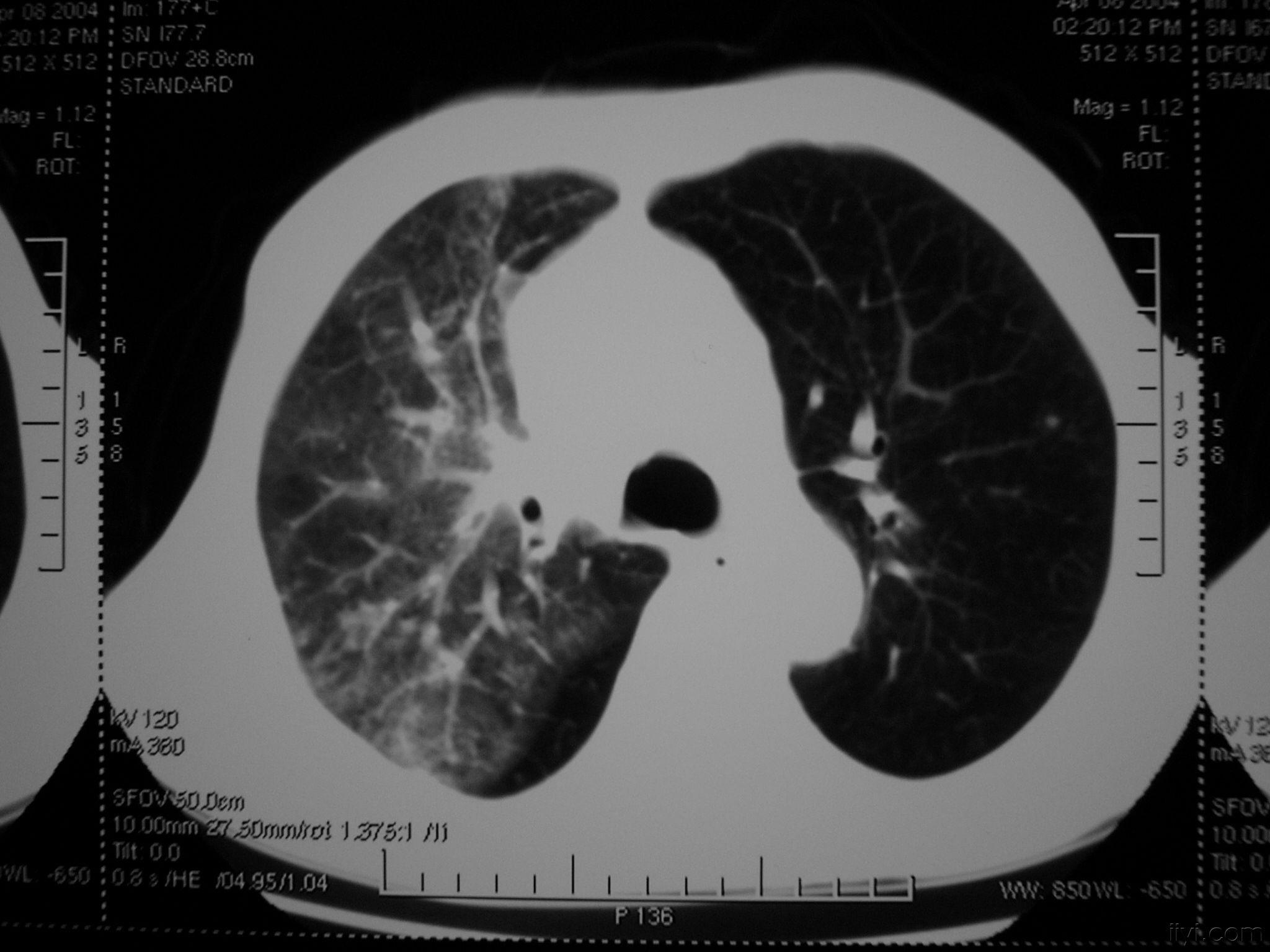 肺淤血ct表现图片图片