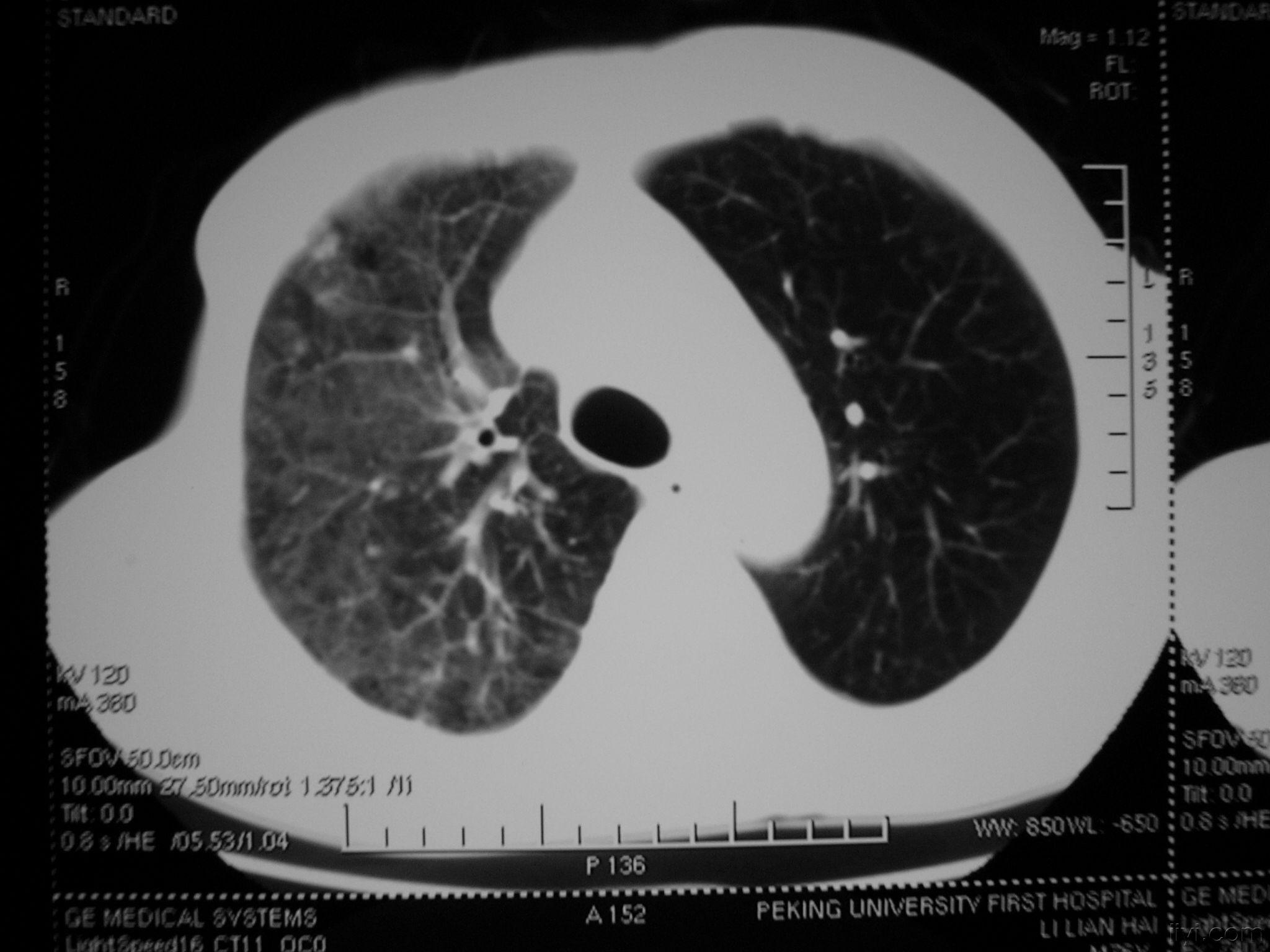 急性肺淤血图片图片