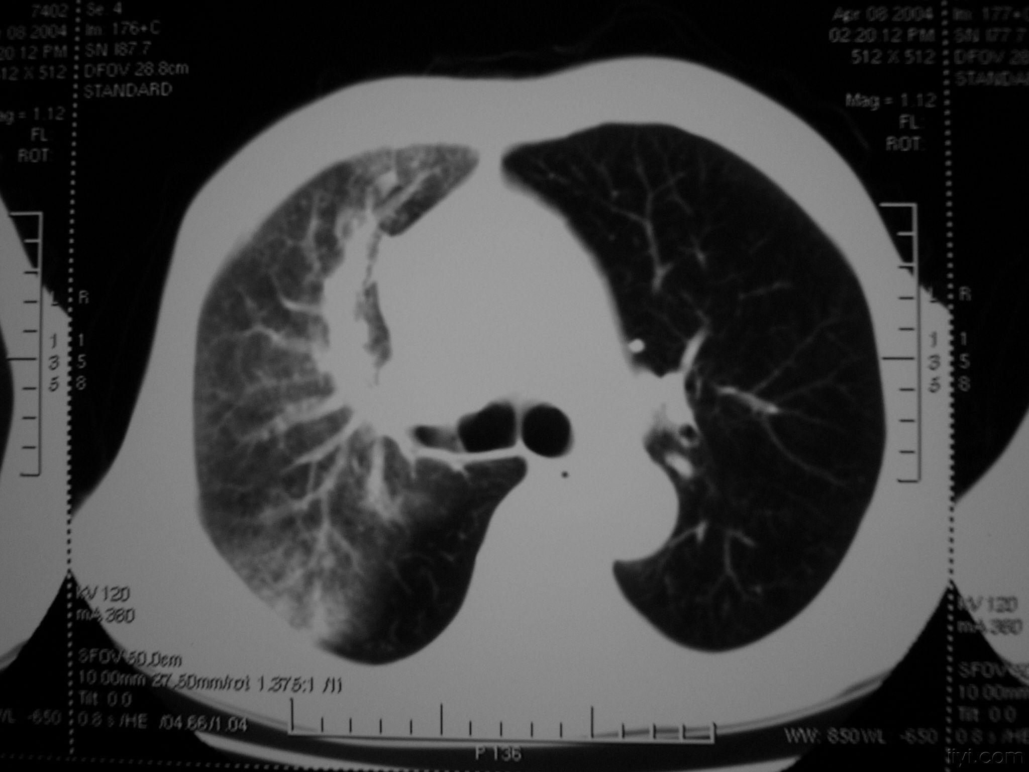 急性肺淤血图片图片