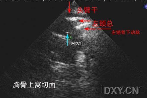 主动脉夹层 超声医学讨论版 爱爱医医学论坛