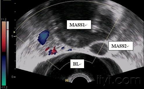 盆腔包块一例术后诊断右输卵管系膜囊肿
