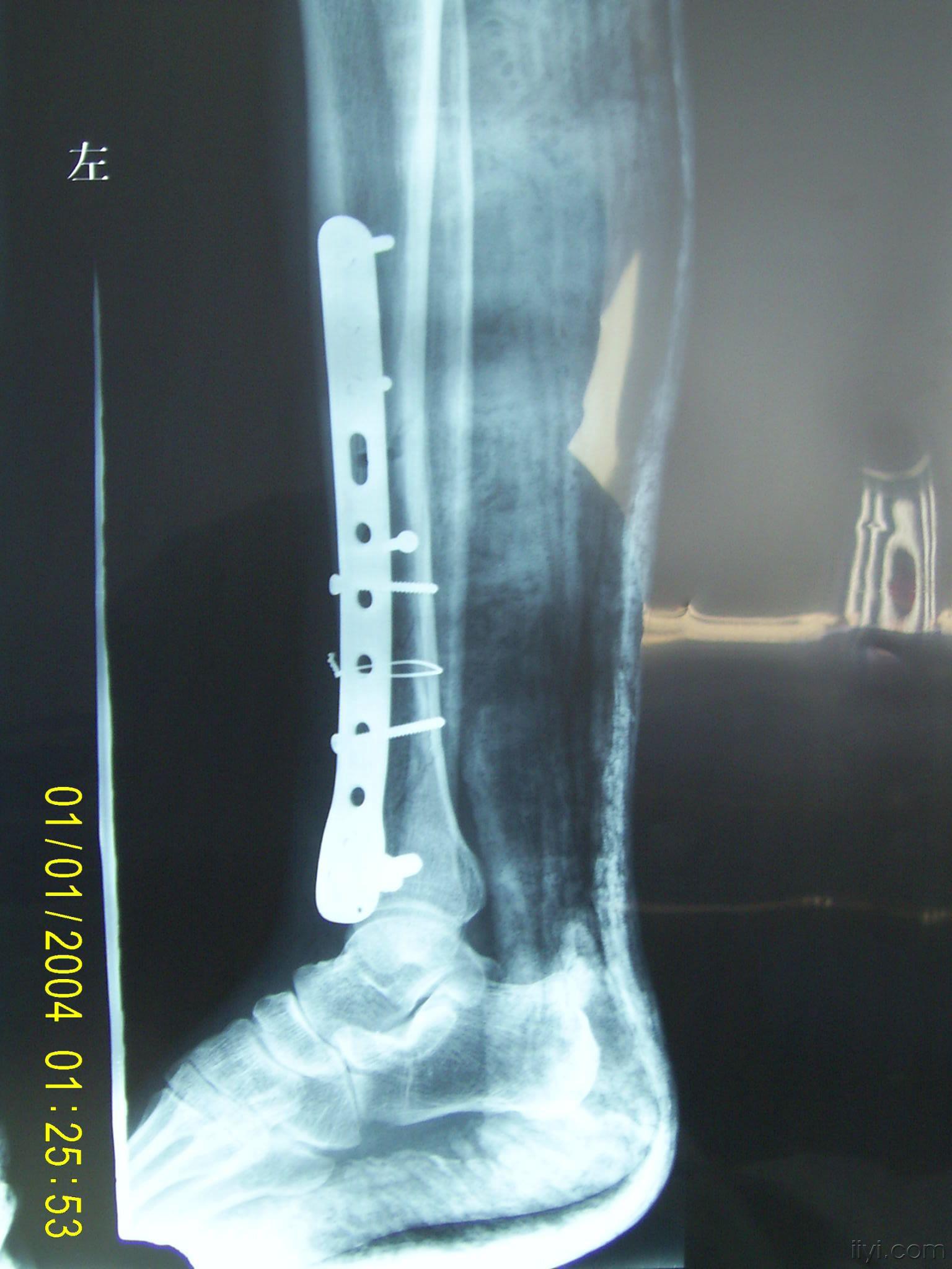 欢迎指导胫腓骨粉碎性骨折的手术治疗