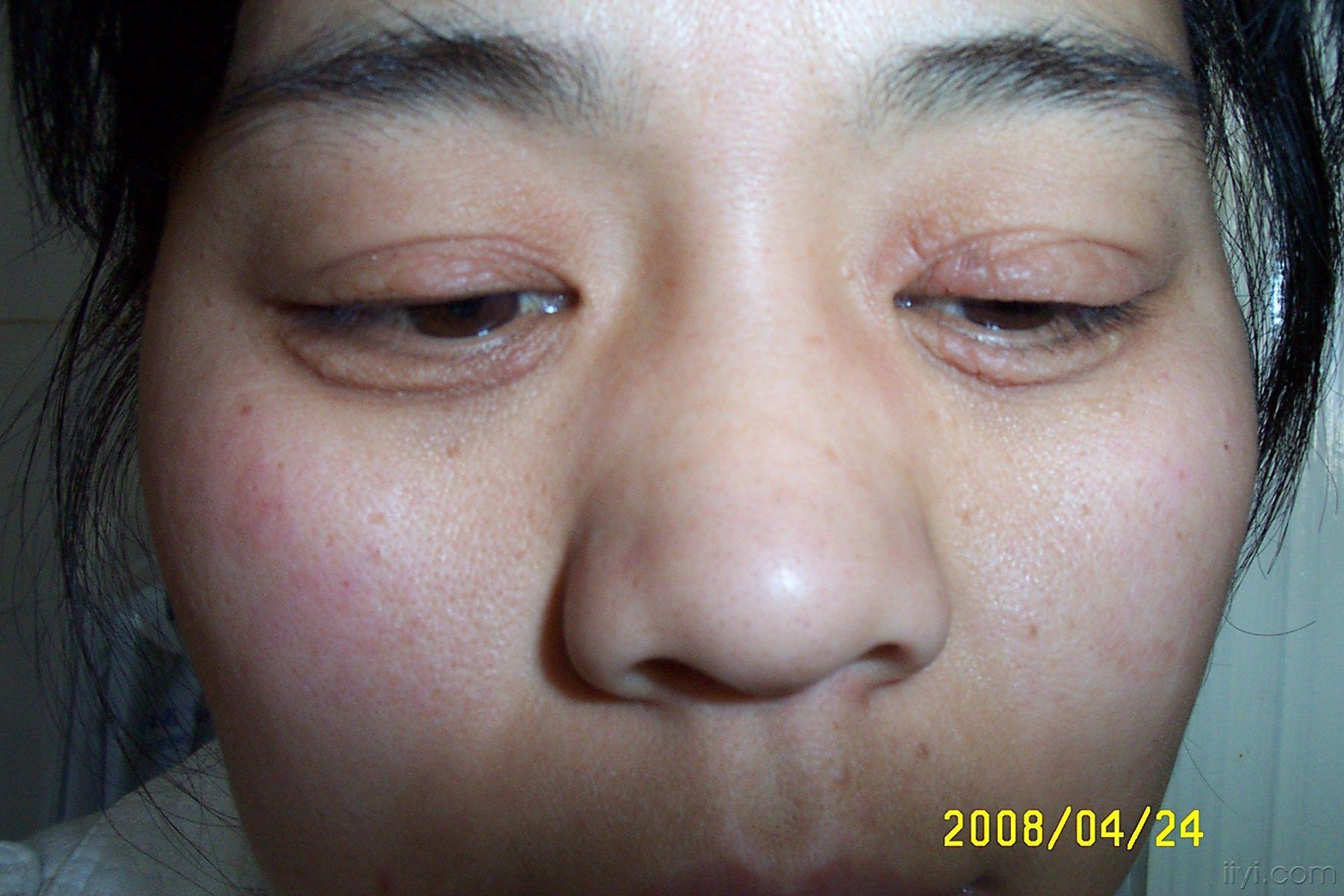 过敏性眼睑皮炎图片