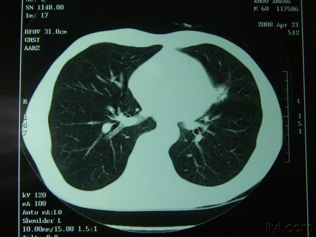 左肺舌段肿物性质待查结核肺癌