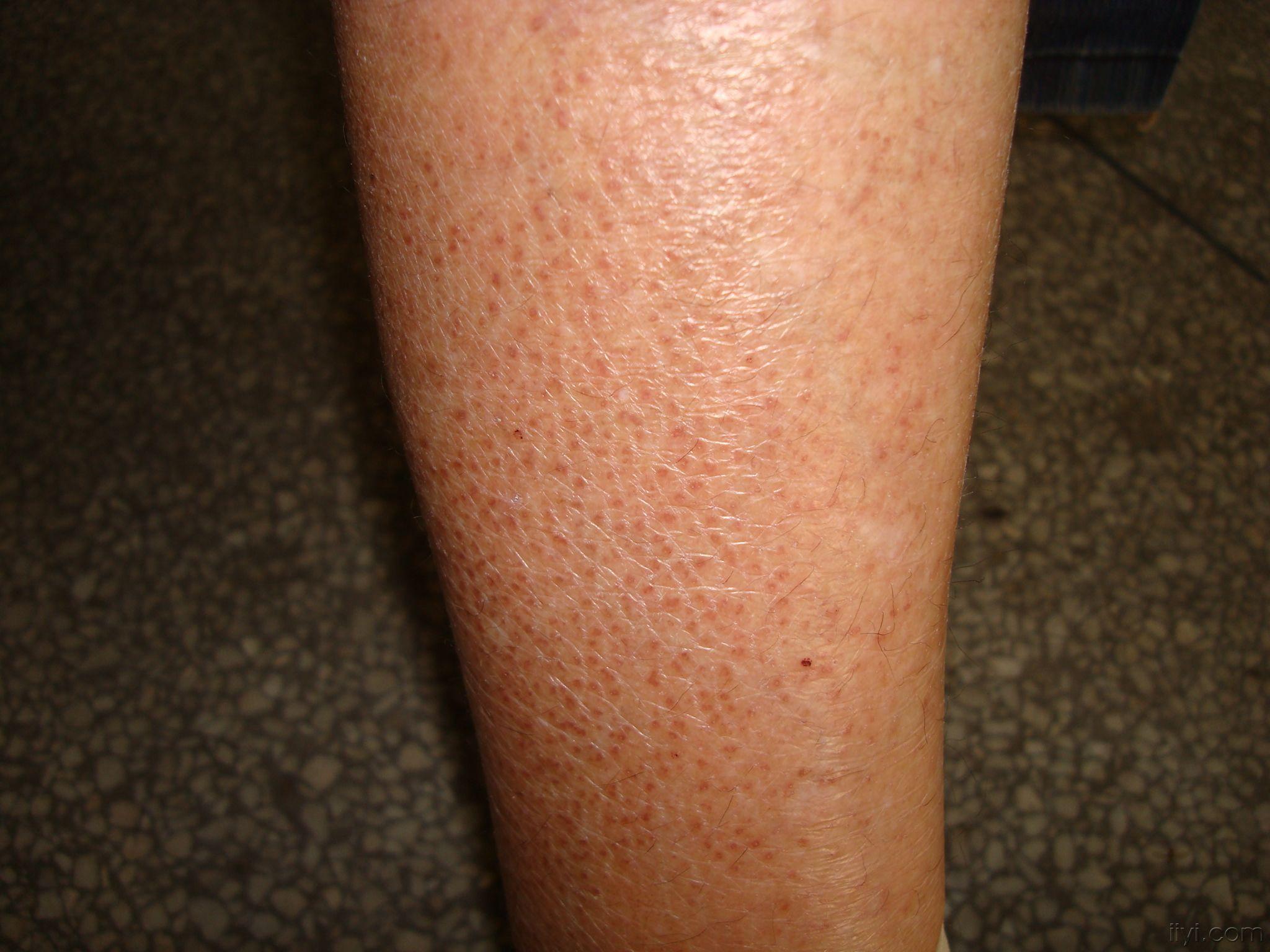 大家看看这个是什么皮肤病?