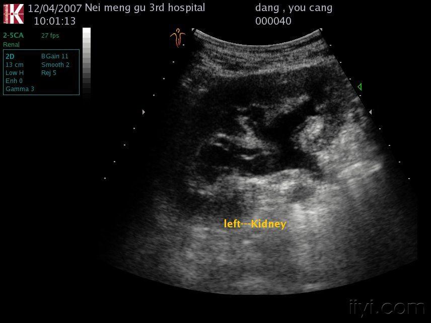 肾结核超声图片