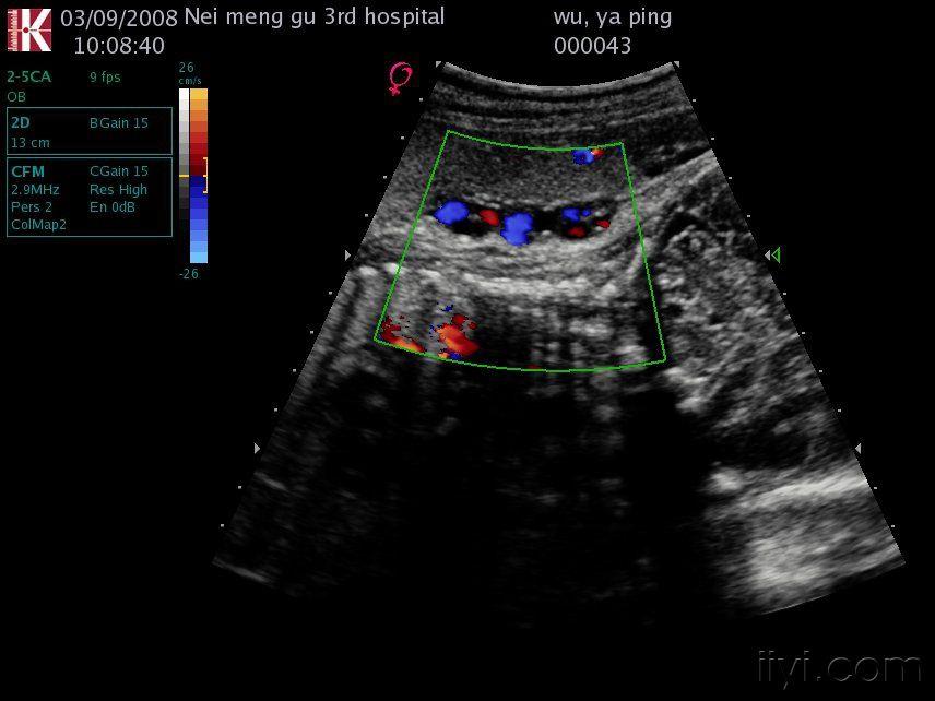 脐绕颈 超声医学讨论版 爱爱医医学论坛