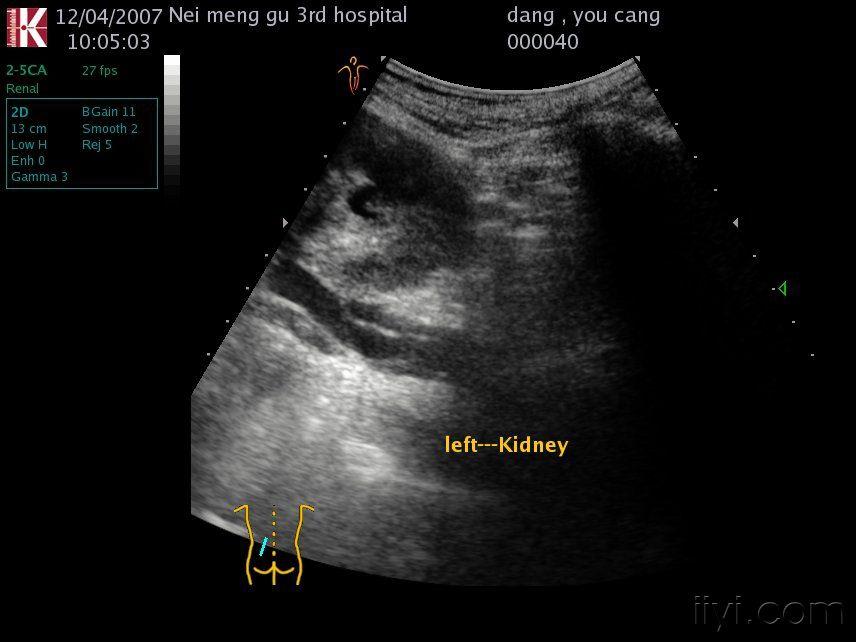 肾结核超声图片