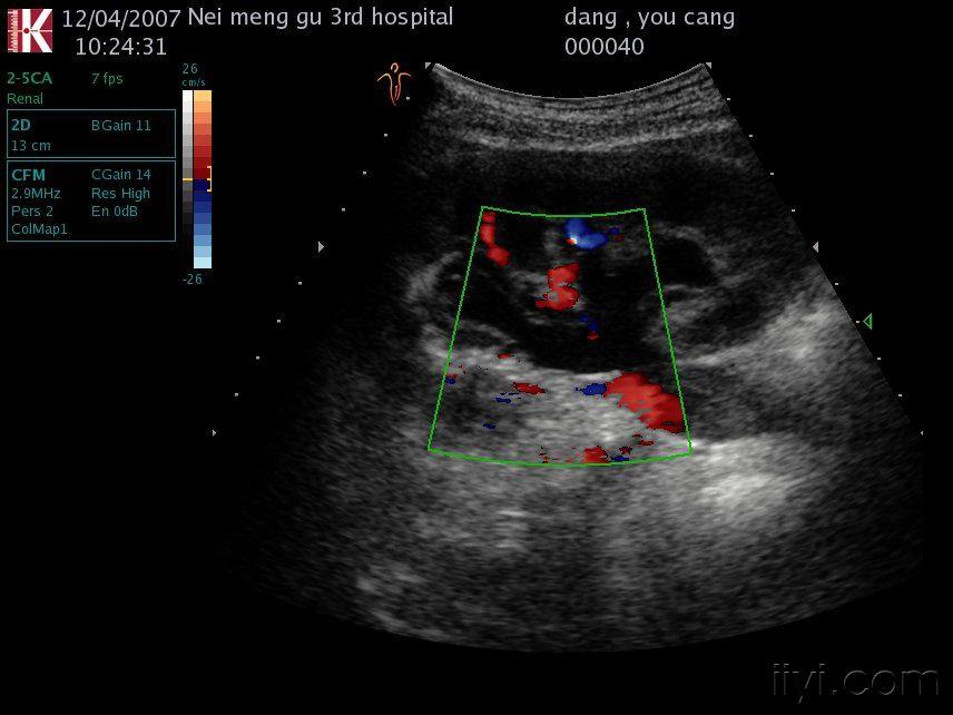 怀疑肾结核 超声医学讨论版 爱爱医医学论坛