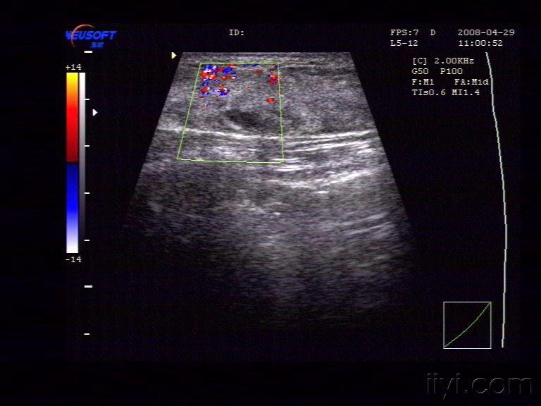 乳腺囊性增生 - 超声医学讨论版 - 爱爱医医学论坛