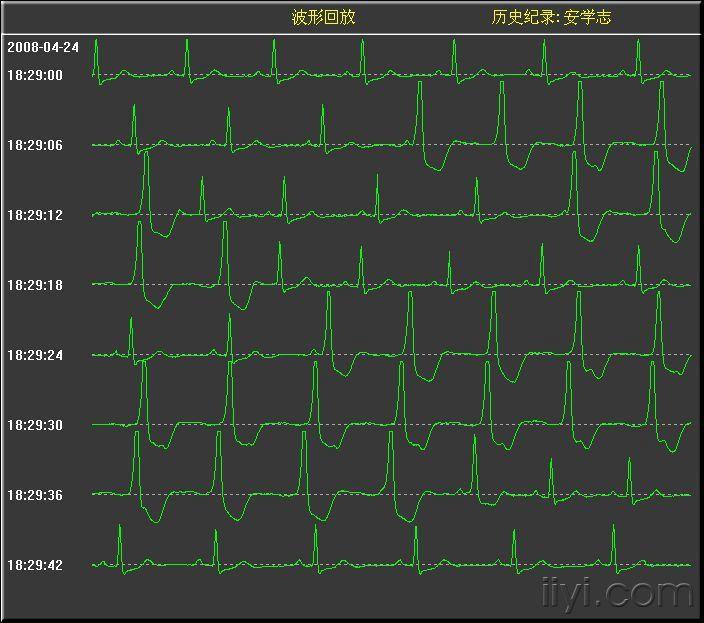 监护仪上的波形图解图片